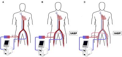 Double Distal Perfusion Catheters for Severe Limb Ischemia on the IABP Side in Patients Who Received Femoro-Femoral VA-ECMO With IABP